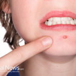 The Root Cause of Acne (Which is Ignored by Conventional Allopathic Medicine)