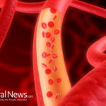 Clogged Heart Artery – You Can Reverse It Naturally