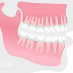 Are Dental Implants Safe?