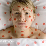 Chicken pox, measles, mumps and whooping cough treatments