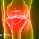 Five Natural Ways to Avoid Knee Surgery