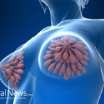 Stanford Study: A Clear Link Between Breast Cancer Chemo, Chemo Brain and Brain Abnormalities