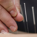5 Reasons to Try Acupuncture for Baby Eczema