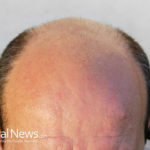 5 Natural Remedies For Hair Loss