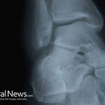 Broken Bone: Types, Cause and 5 Possible Conditions